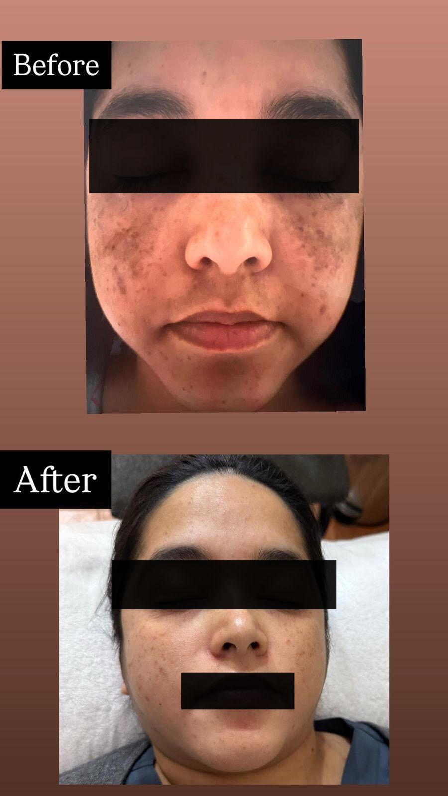 Pigmentation Result Before After